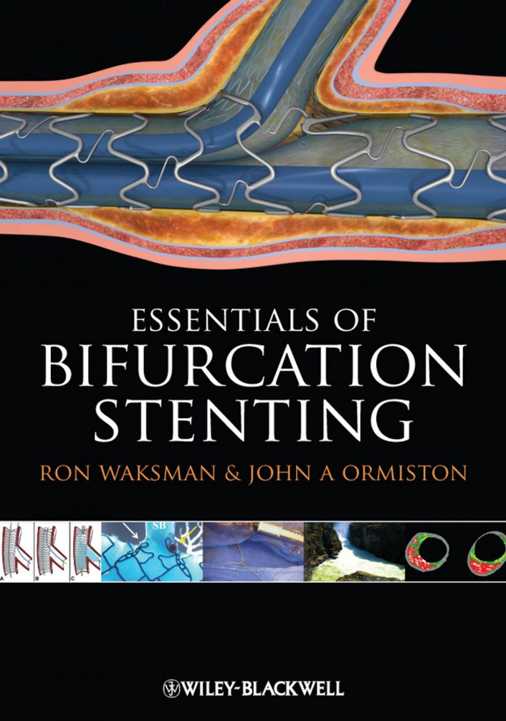 Big bigCover of Bifurcation Stenting