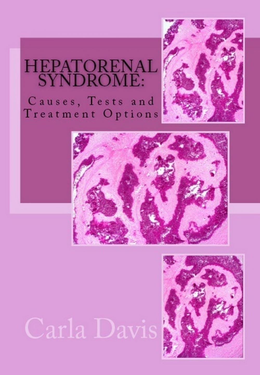 Big bigCover of Hepatorenal Syndrome: Causes, Tests, and Treatment Options