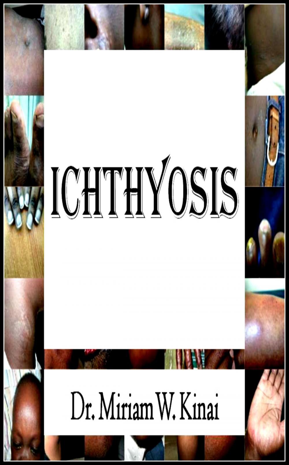 Big bigCover of Ichthyosis