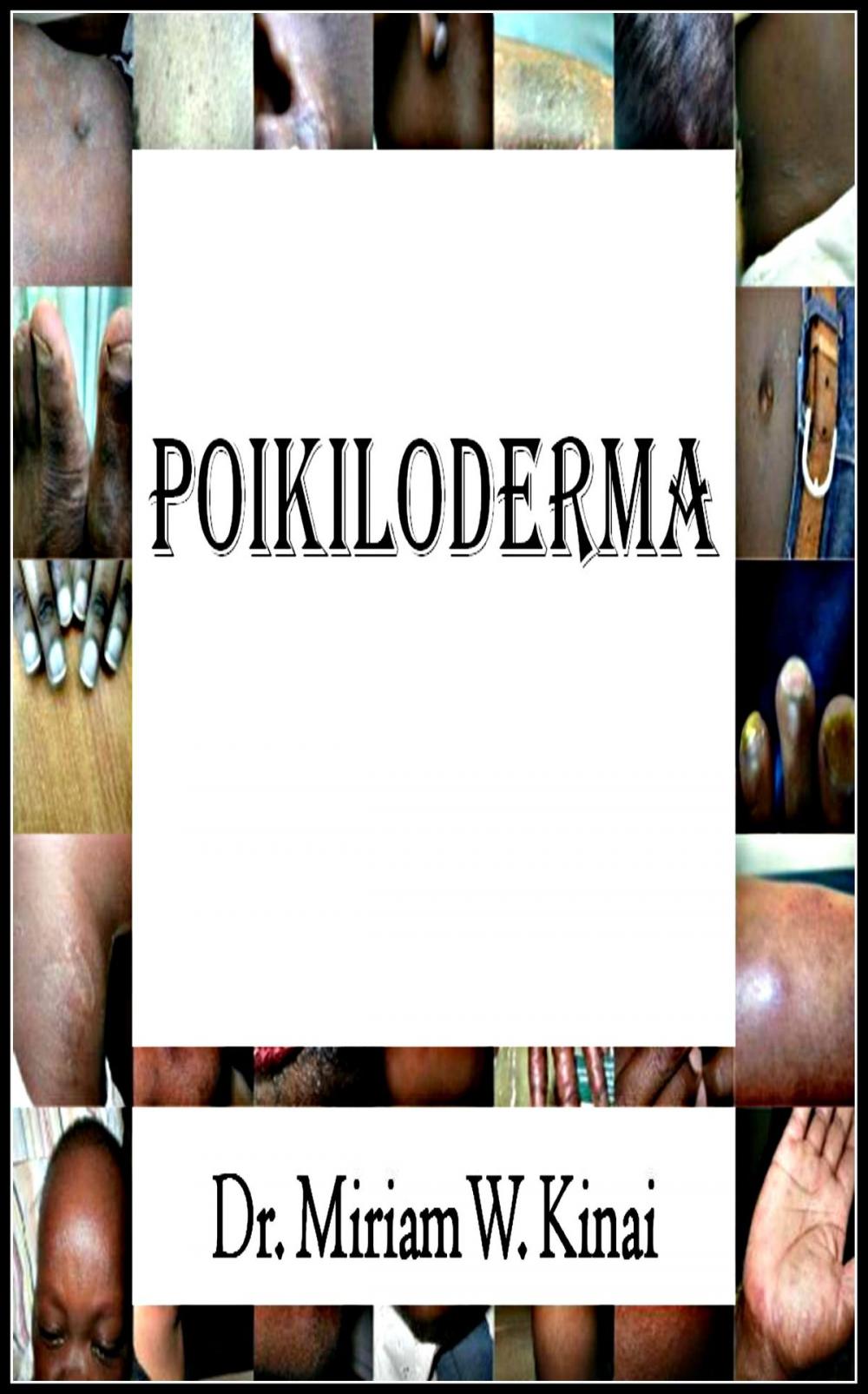 Big bigCover of Poikiloderma