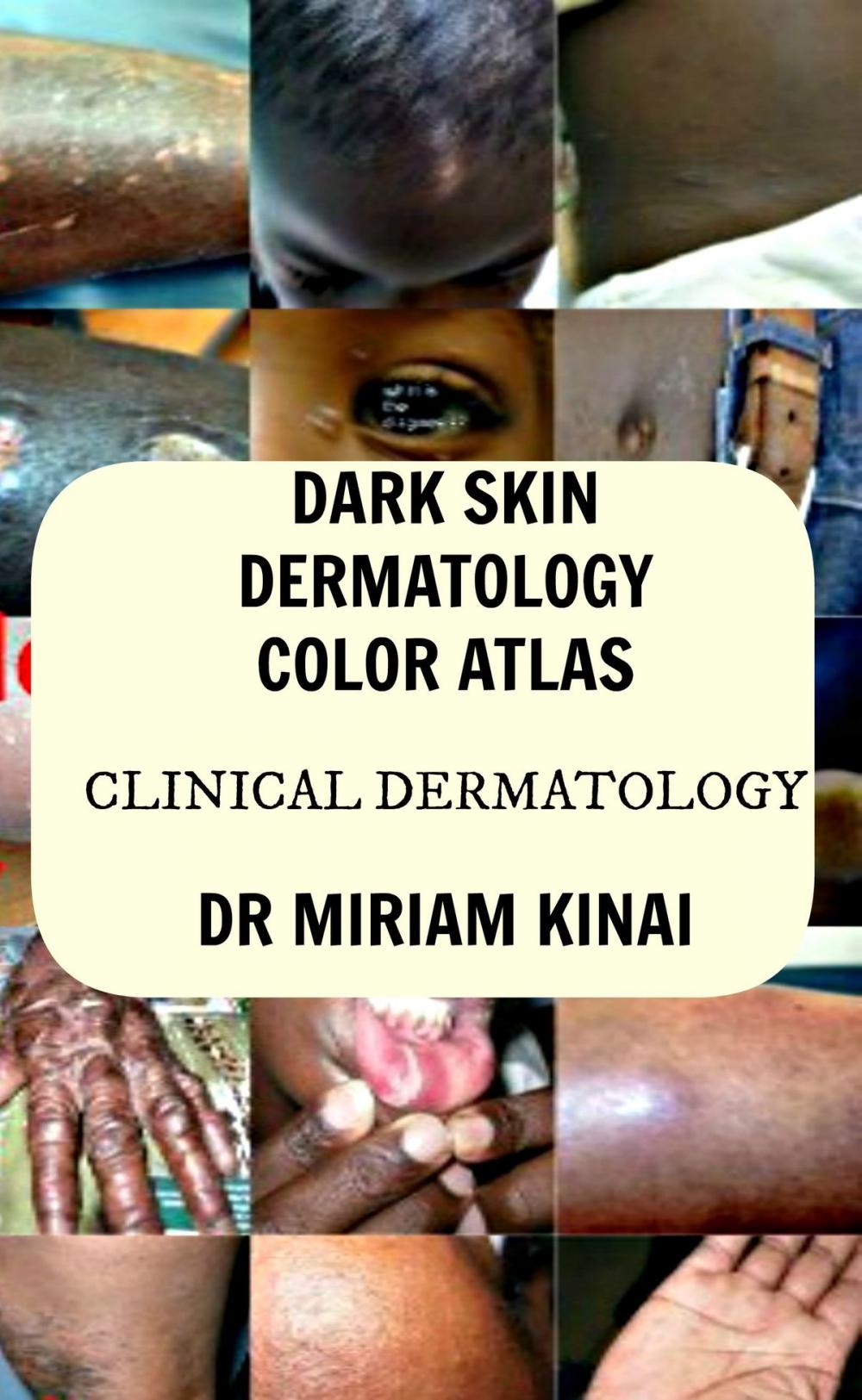 Big bigCover of Dark Skin Dermatology Color Atlas