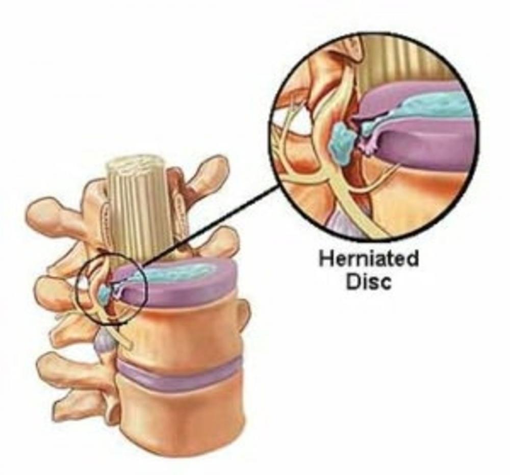 Big bigCover of An Informative Guide About Herniated Disks