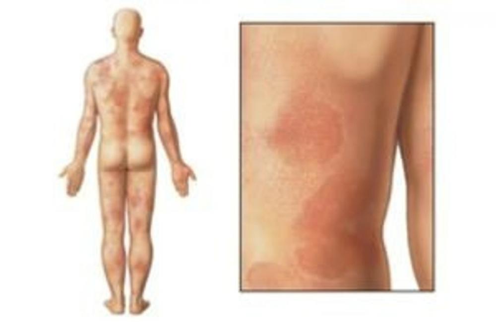 Big bigCover of Chronic Hives: Causes, Symptoms and Treatments