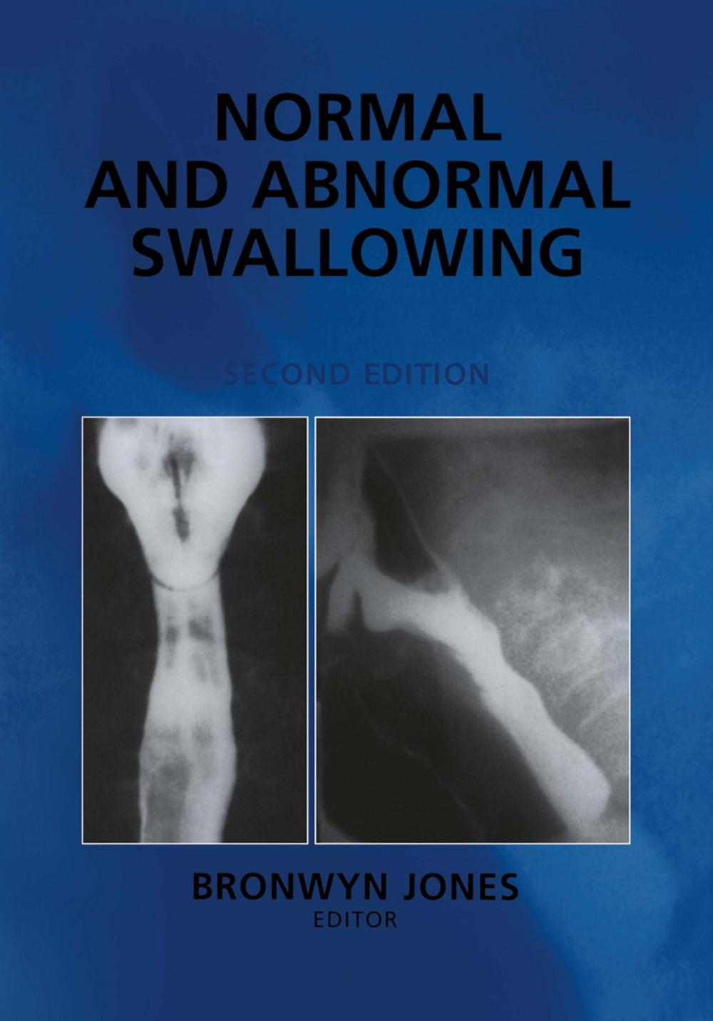 Big bigCover of Normal and Abnormal Swallowing