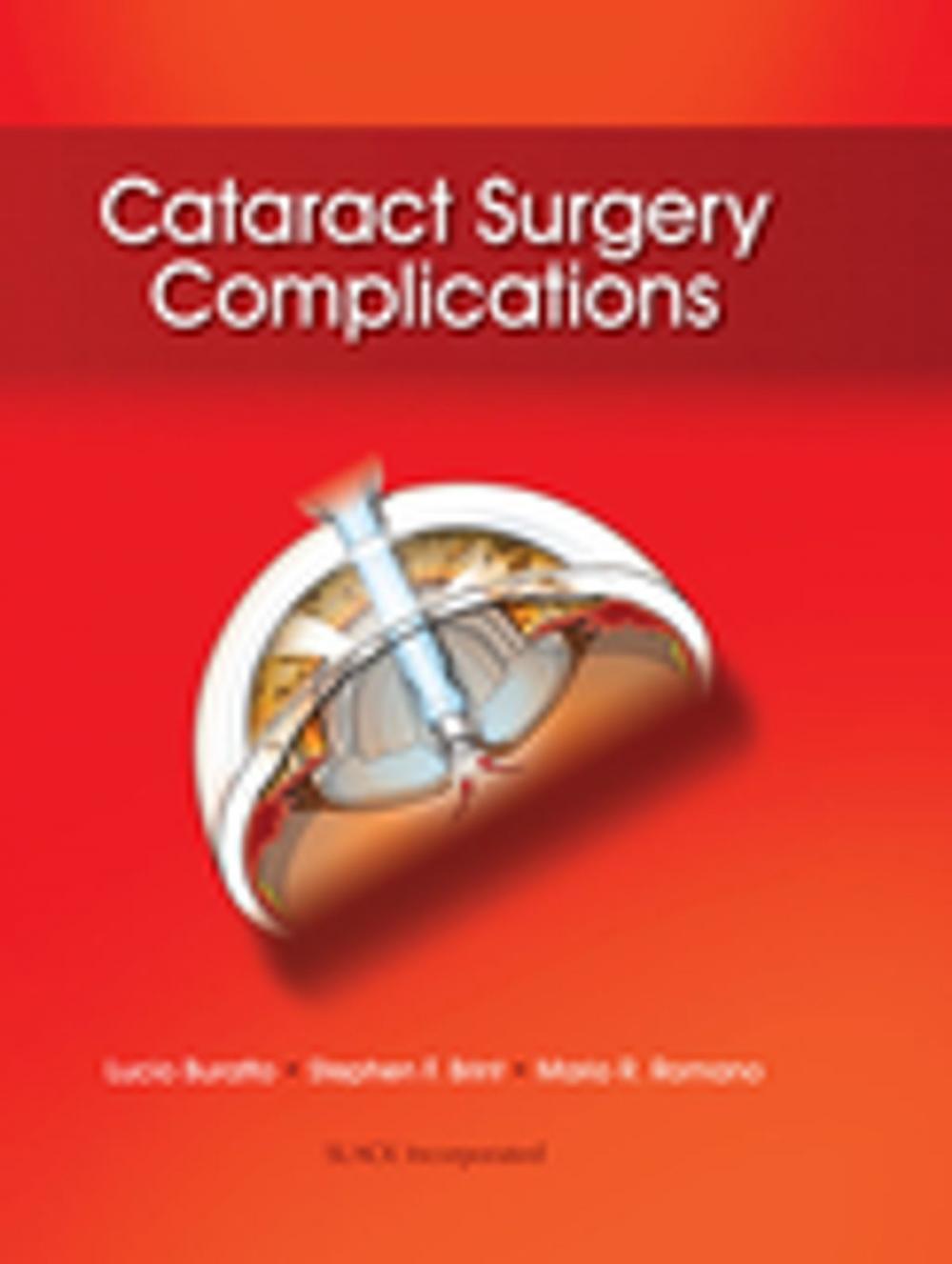 Big bigCover of Cataract Surgery Complications