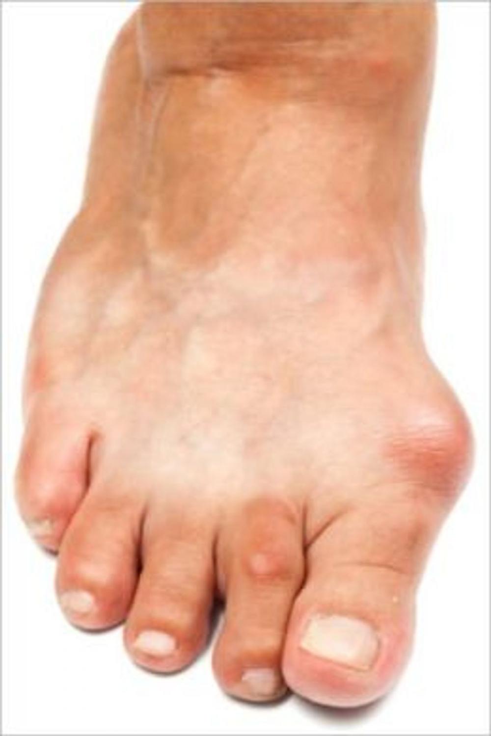 Big bigCover of How To Get Rid Of Bunions