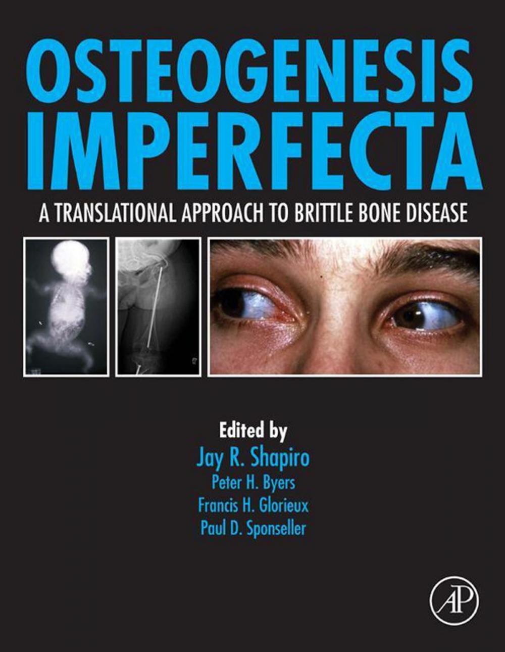 Big bigCover of Osteogenesis Imperfecta