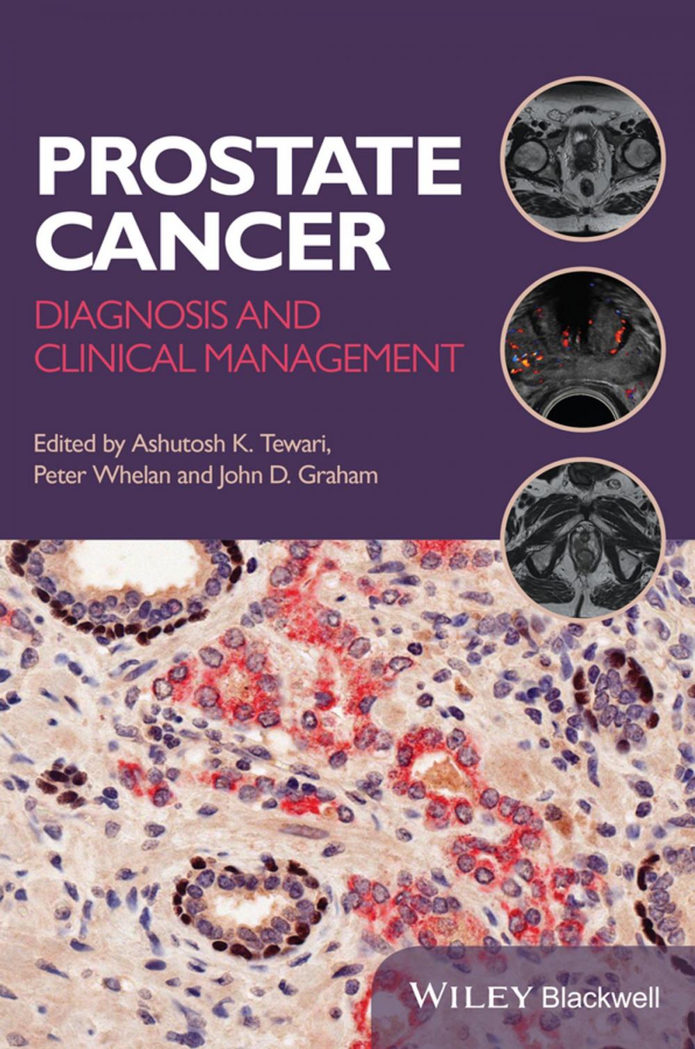 Big bigCover of Prostate Cancer