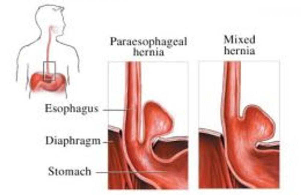 Big bigCover of An Informative Guide About Hernias