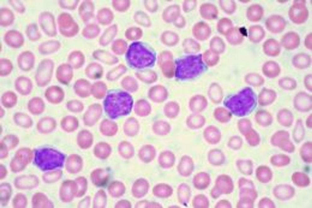 Big bigCover of Chronic Lymphocytic Leukemia: Causes, Symptoms and Treatments