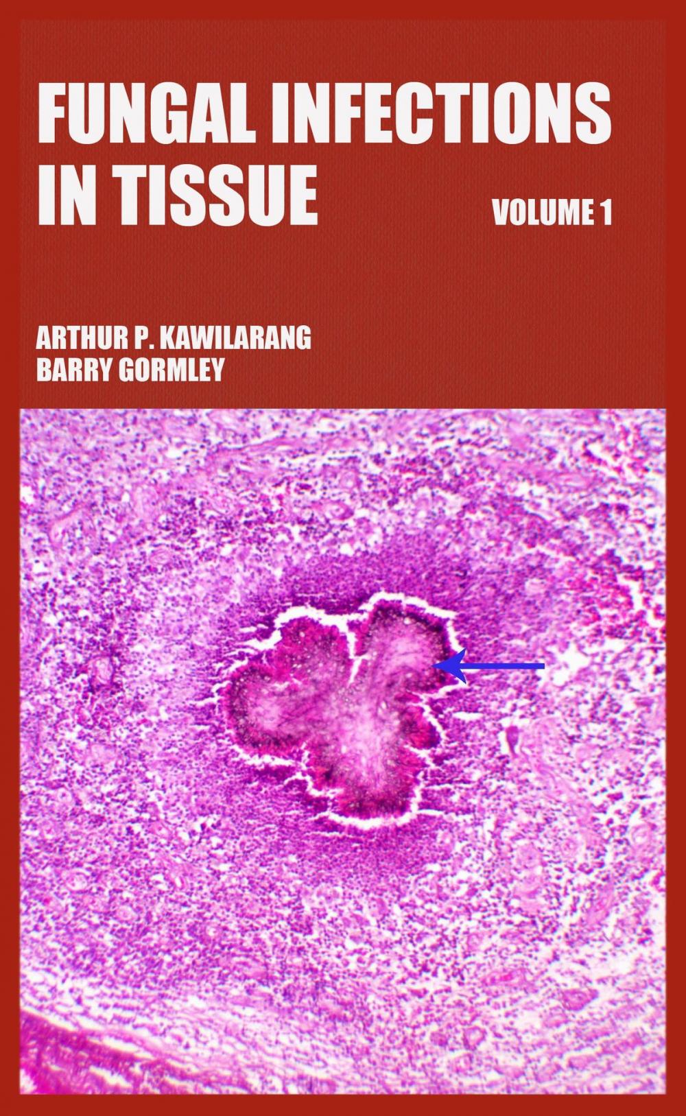 Big bigCover of Fungal Infections in Tissue Volume 1