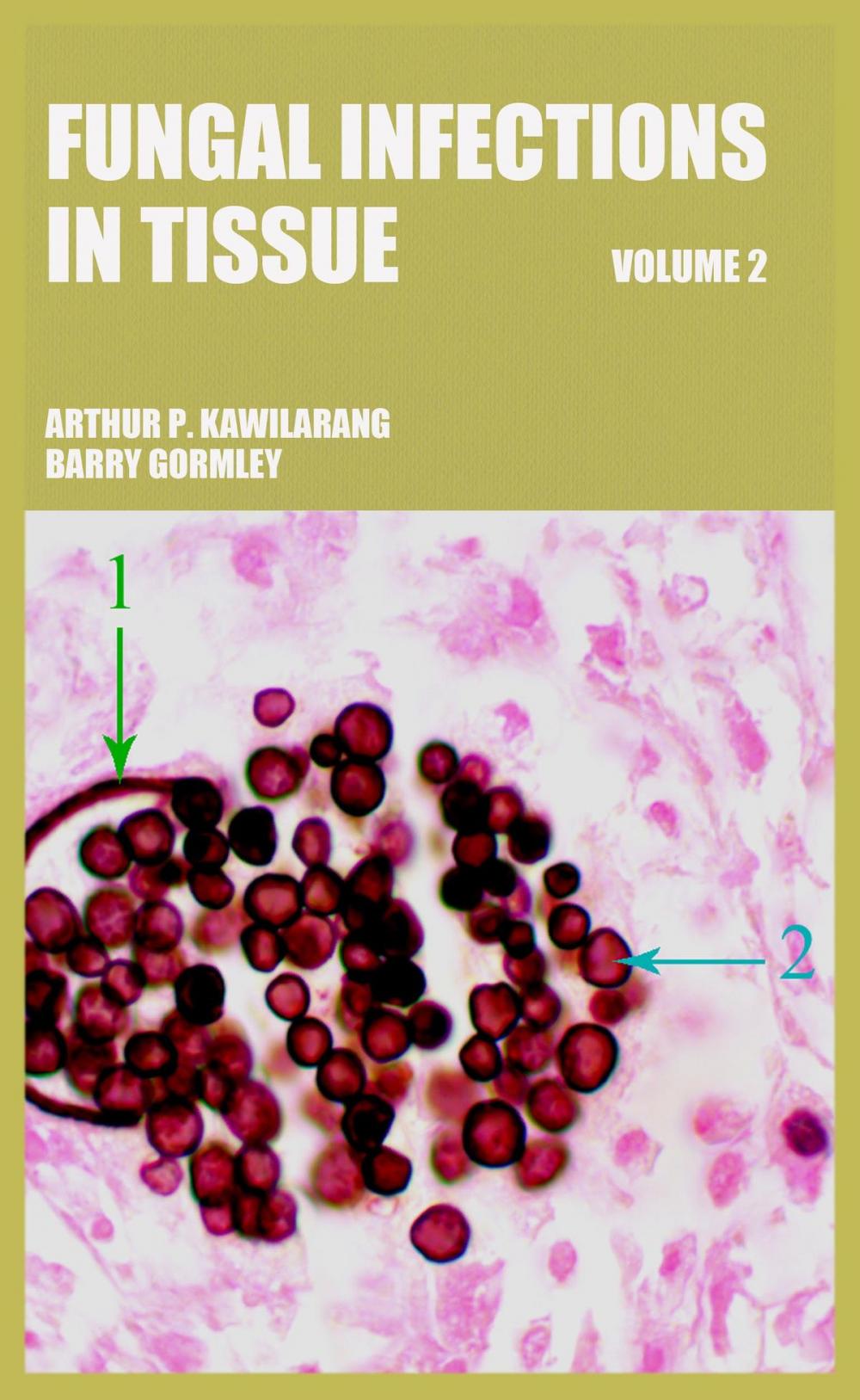 Big bigCover of Fungal Infections in Tissue Volume 2