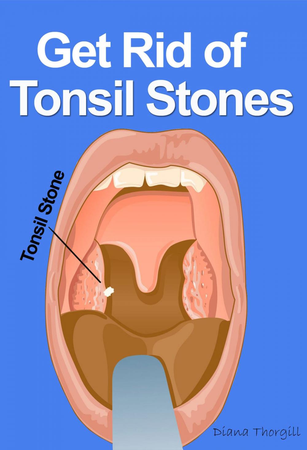 Big bigCover of Get Rid of Tonsil Stones: Causes, Symptoms, Treatment, Removal and Other Remedies