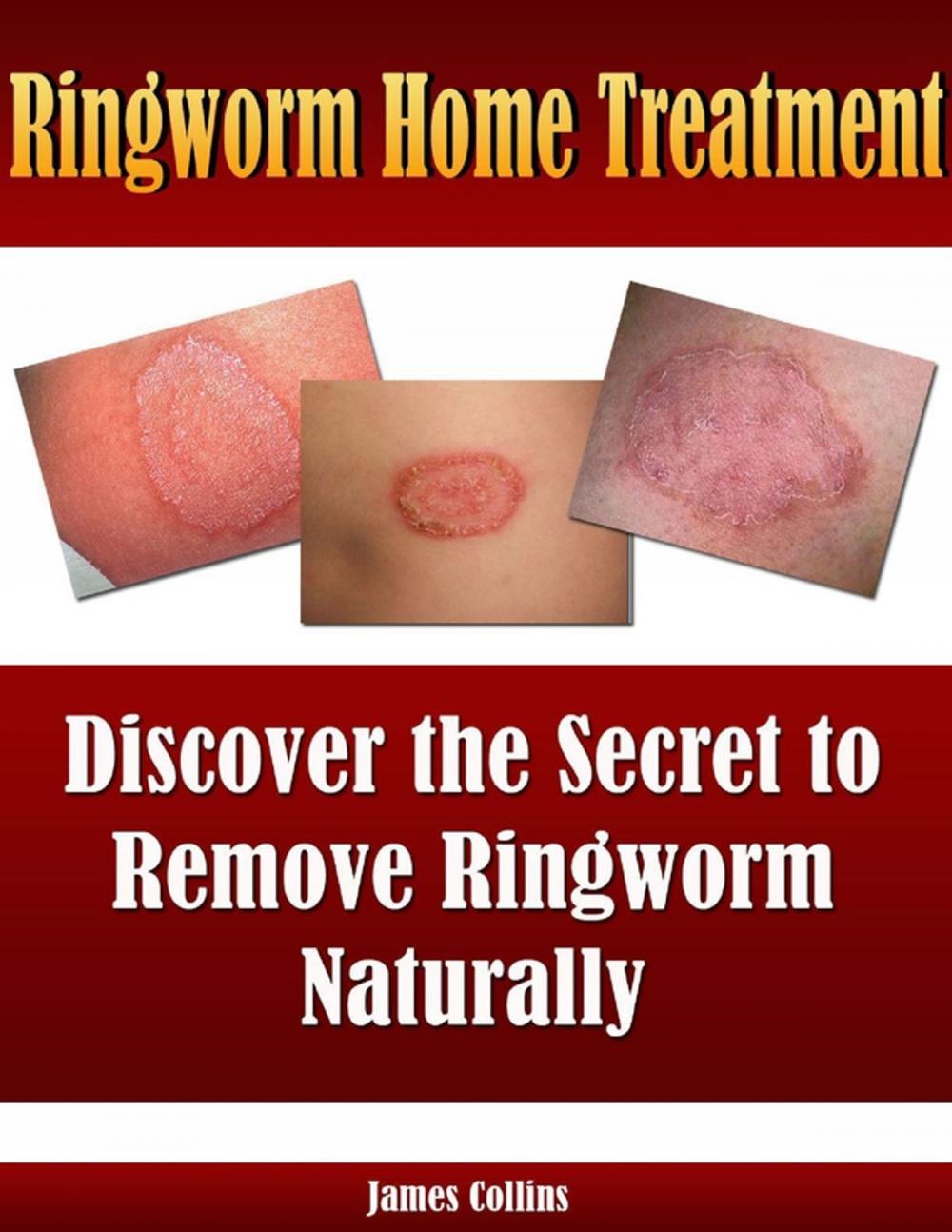 Big bigCover of Ringworm Home Treatment: Discover the Secret to Remove Ringworm Naturally