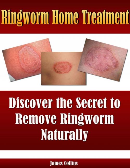 Cover of the book Ringworm Home Treatment: Discover the Secret to Remove Ringworm Naturally by James Collins, Lulu.com
