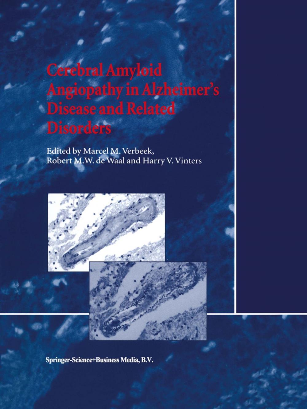 Big bigCover of Cerebral Amyloid Angiopathy in Alzheimer’s Disease and Related Disorders