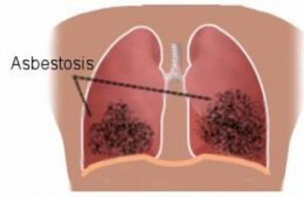 Big bigCover of Asbestosis: Causes, Symptoms and Treatments