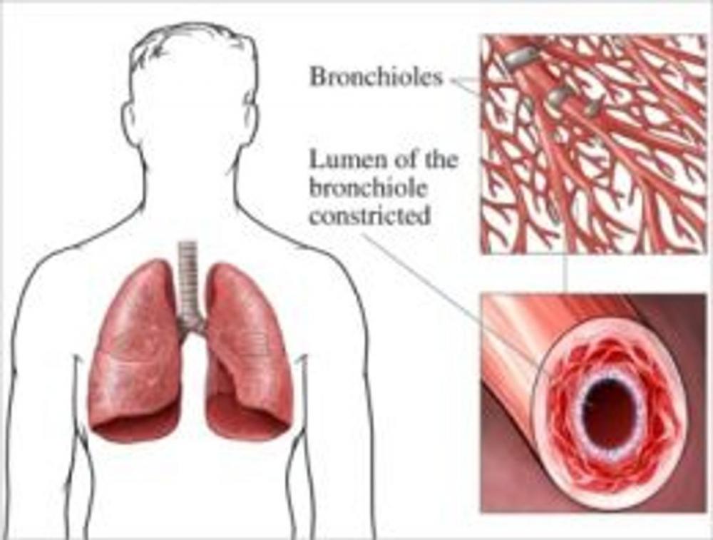 Big bigCover of Aspergillosis: Causes, Symptoms and Treatments