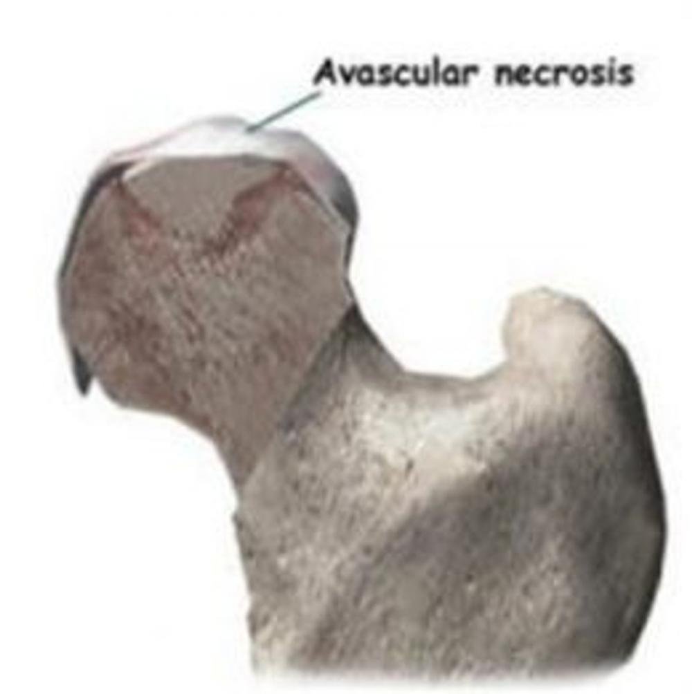 Big bigCover of Avascular Necrosis: Causes, Symptoms and Treatments