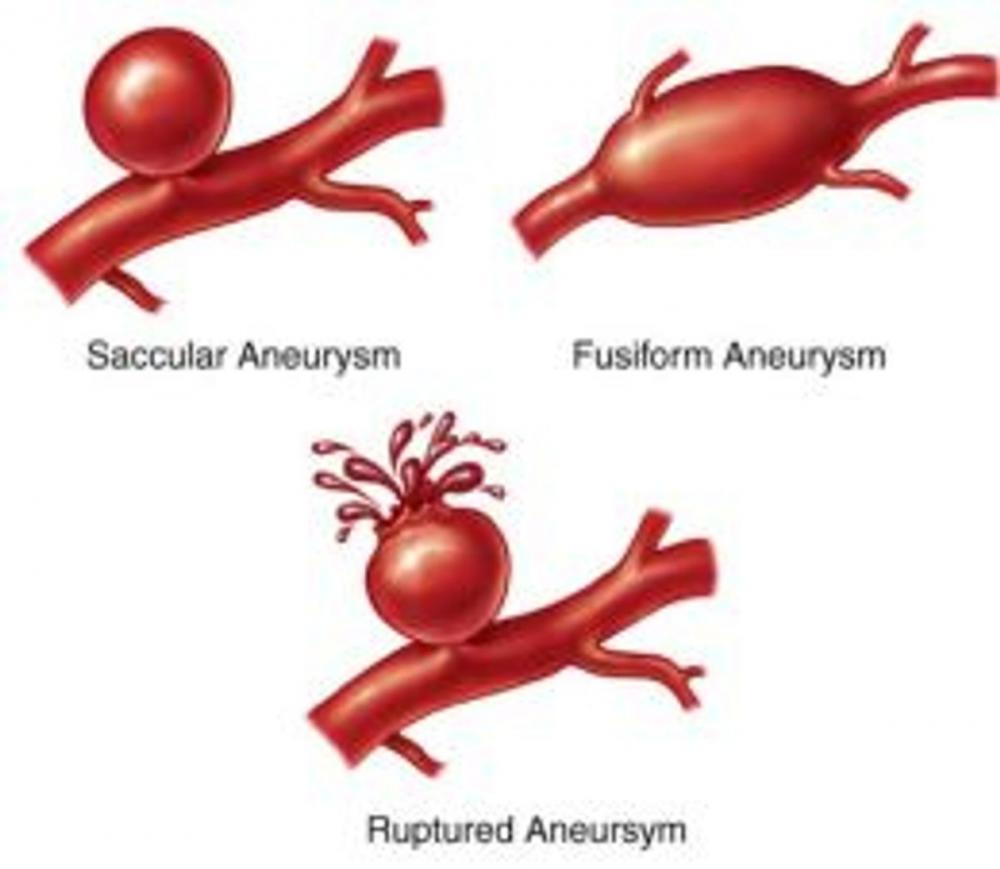 Big bigCover of Brain Aneurysm: Causes, Symptoms and Treatments