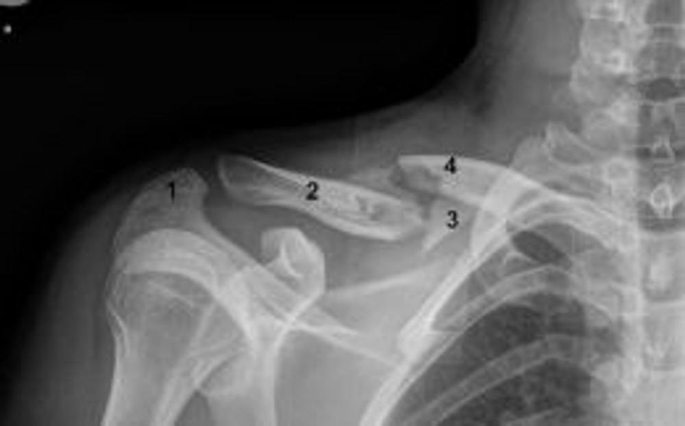 Big bigCover of Broken Collarbone: Causes, Symptoms and Treatments