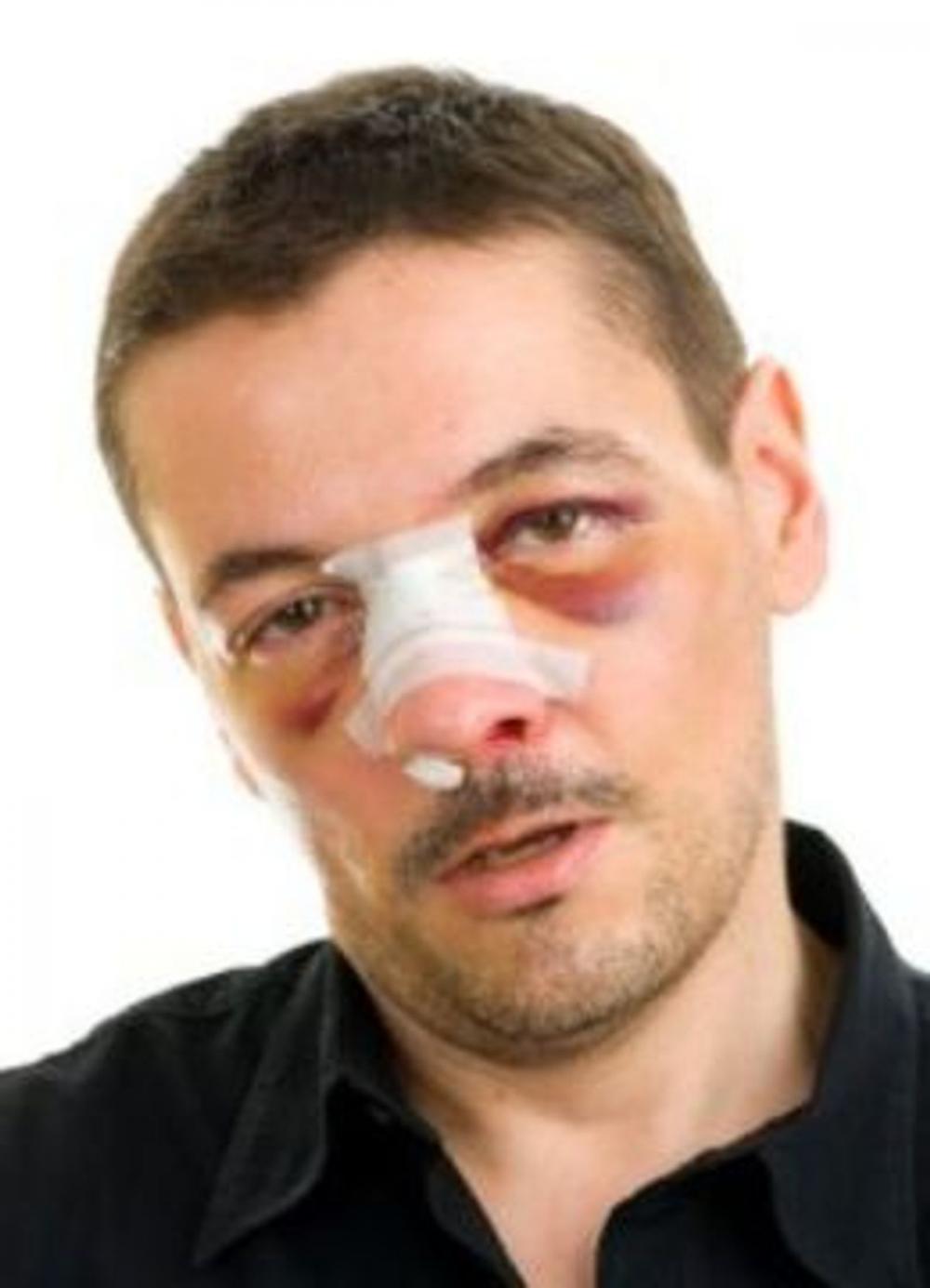 Big bigCover of Broken Nose: Causes, Symptoms and Treatments