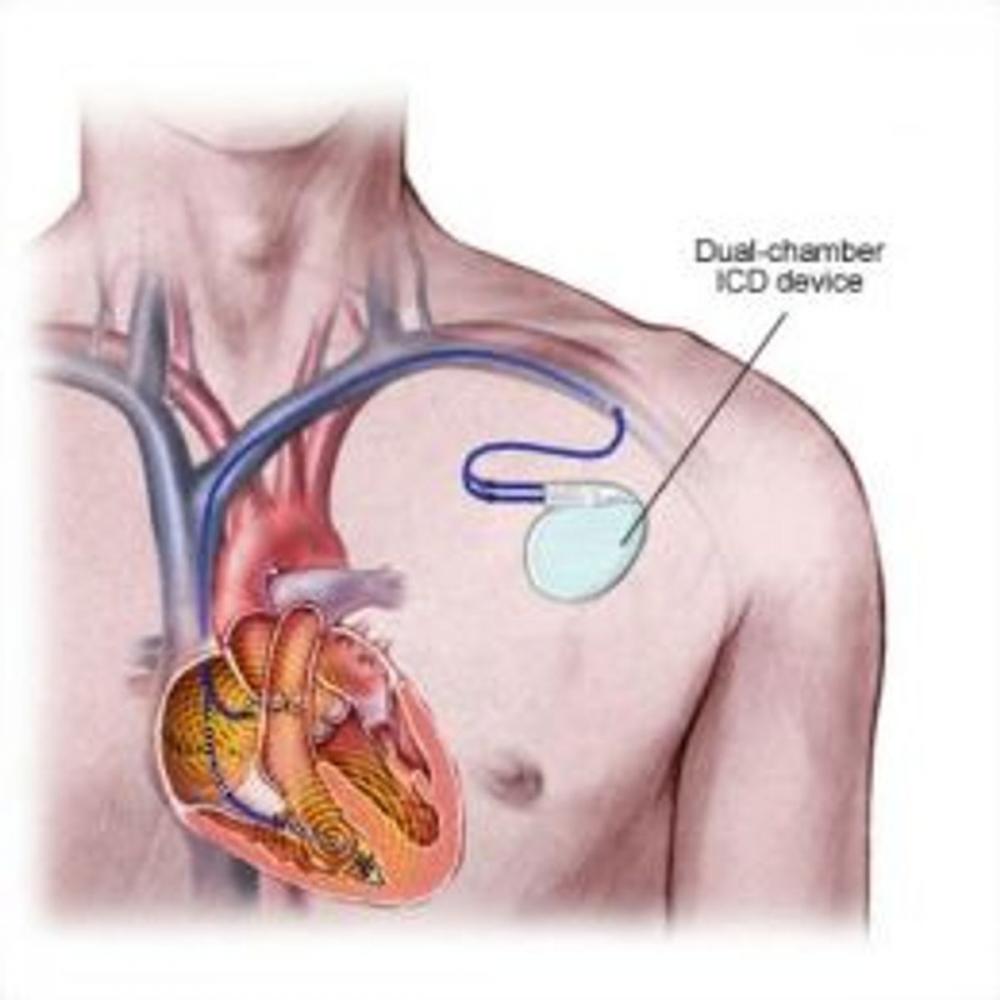 Big bigCover of Brugada Syndrome: Causes, Symptoms and Treatments