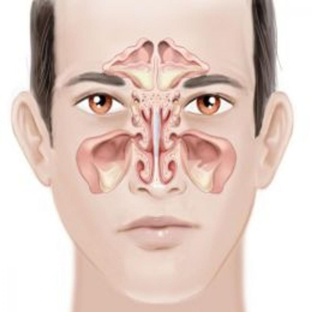 Big bigCover of Chronic Sinusitis: Causes, Symptoms and Treatments