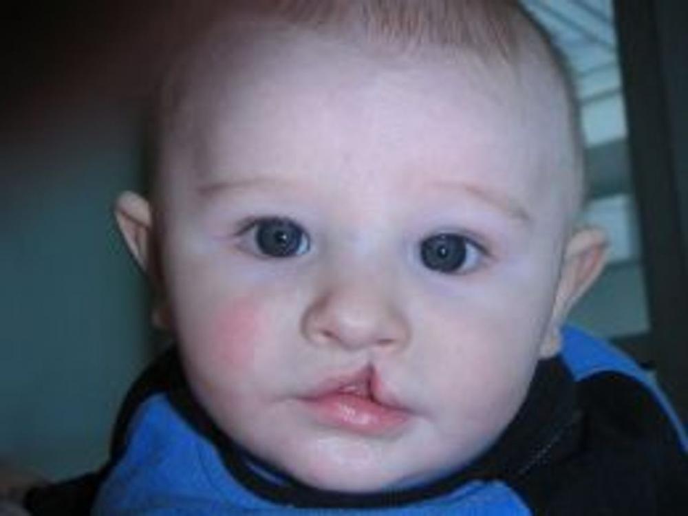 Big bigCover of Cleft Lip and Cleft Palate: Causes, Symptoms and Treatments