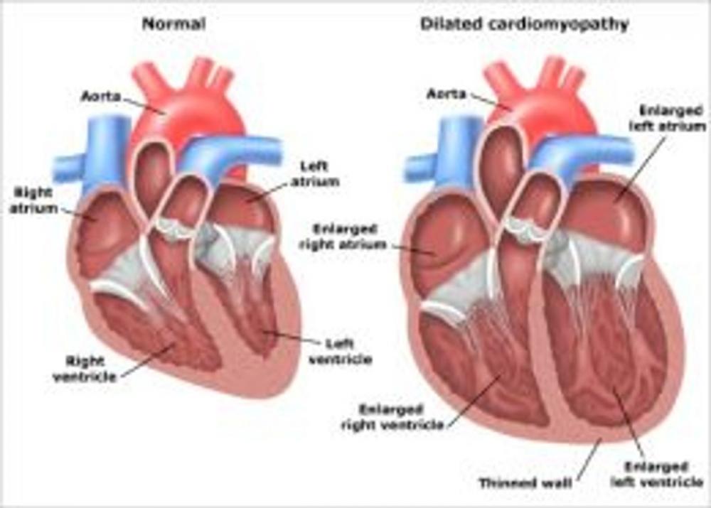 Big bigCover of Dilated Cardiomyopathy: Causes, Symptoms and Treatments