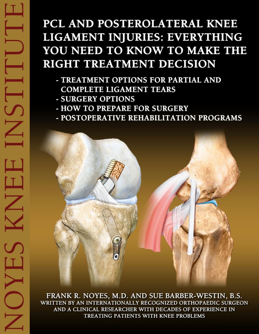 Big bigCover of PCL and Posterolateral Knee Ligament Injuries: Everything You Need to Know to Make the Right Treatment Decision