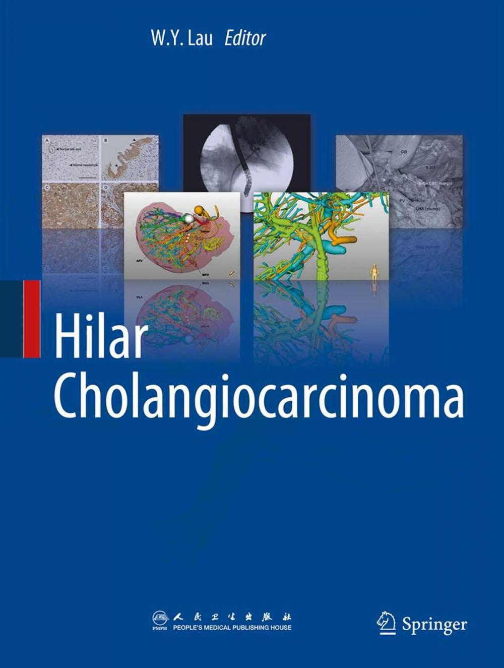 Big bigCover of Hilar Cholangiocarcinoma