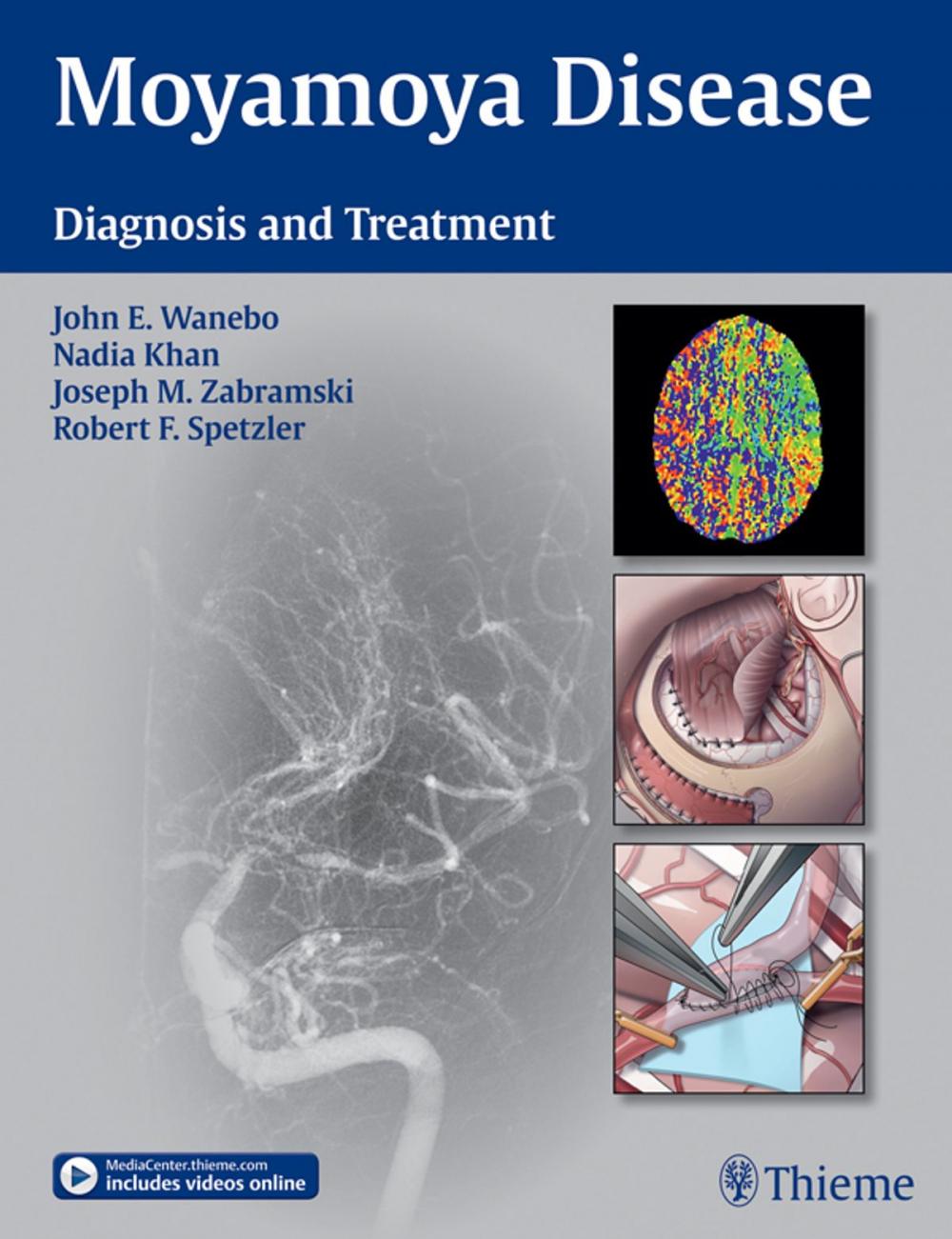 Big bigCover of Moyamoya Disease