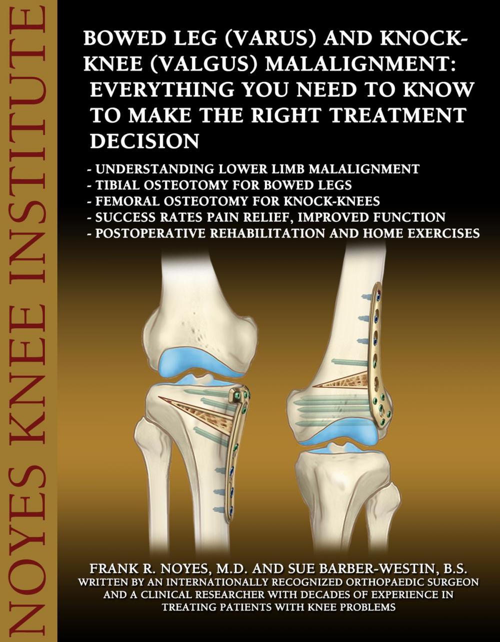 Big bigCover of Bowed Leg (Varus) and Knock-Knee (Valgus) Malalignment: Everything You Need to Know to Make the Right Treatment Decision