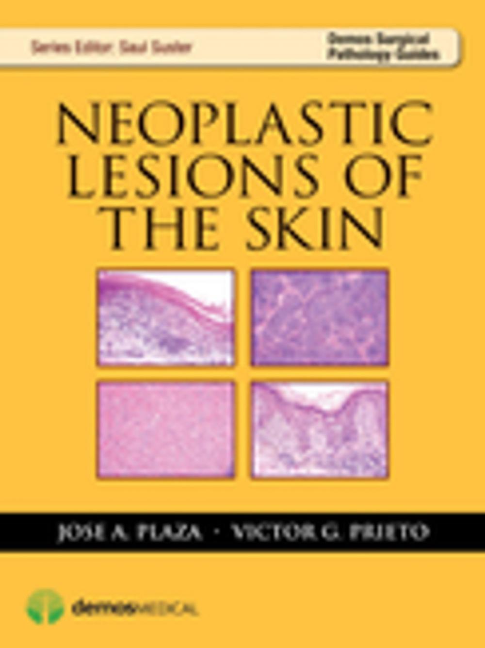 Big bigCover of Neoplastic Lesions of the Skin