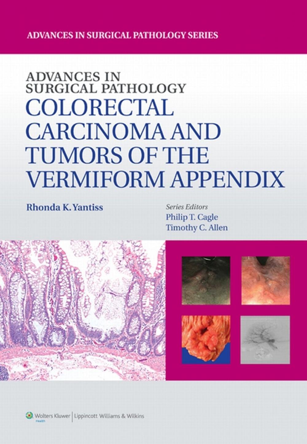 Big bigCover of Advances in Surgical Pathology: Colorectal Carcinoma and Tumors of the Vermiform Appendix