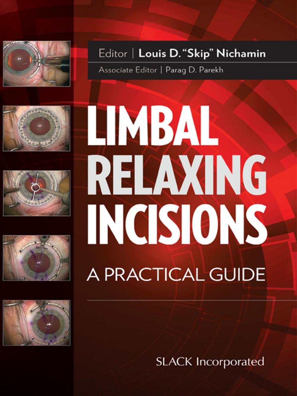 Big bigCover of Limbal Relaxing Incisions