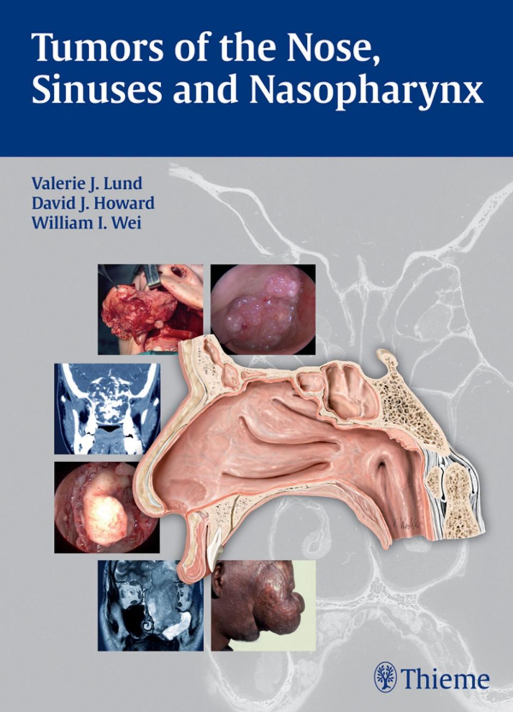 Big bigCover of Tumors of the Nose, Sinuses and Nasopharynx