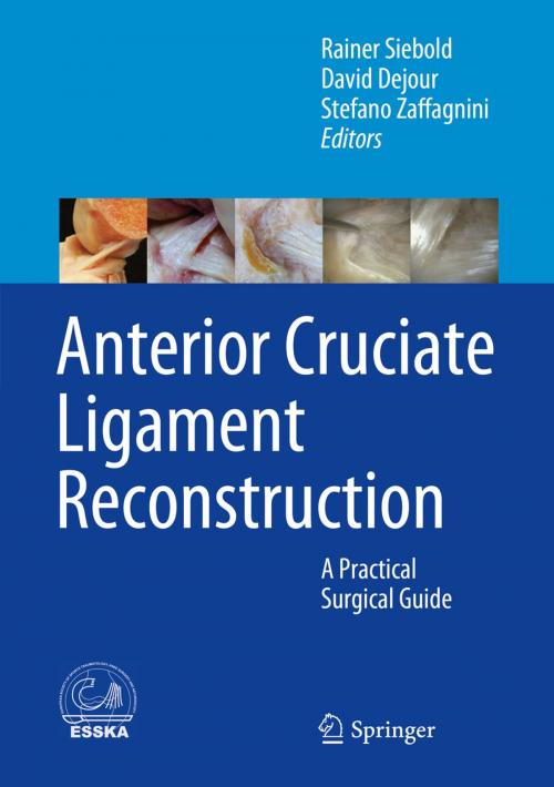 Cover of the book Anterior Cruciate Ligament Reconstruction by , Springer Berlin Heidelberg