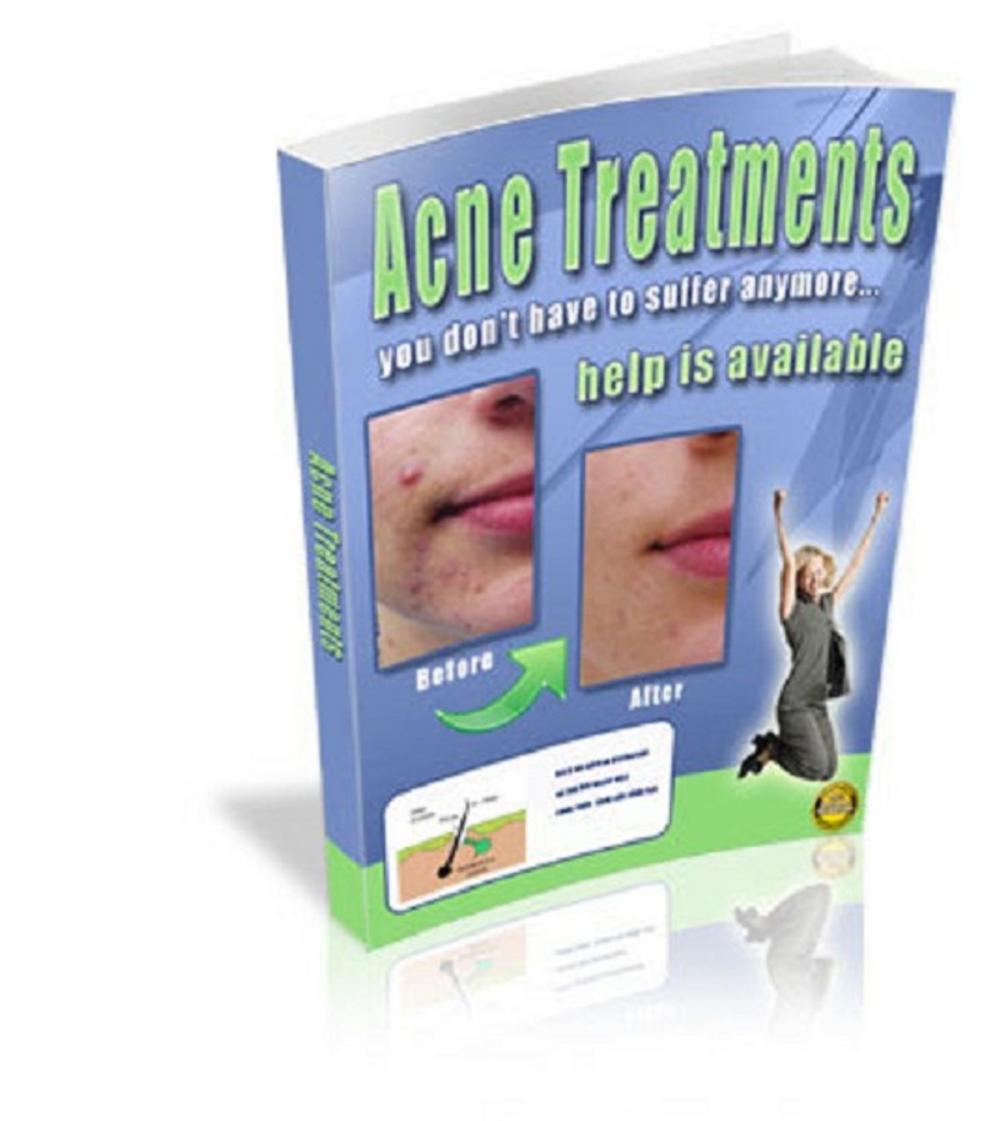 Big bigCover of Acne Treatments