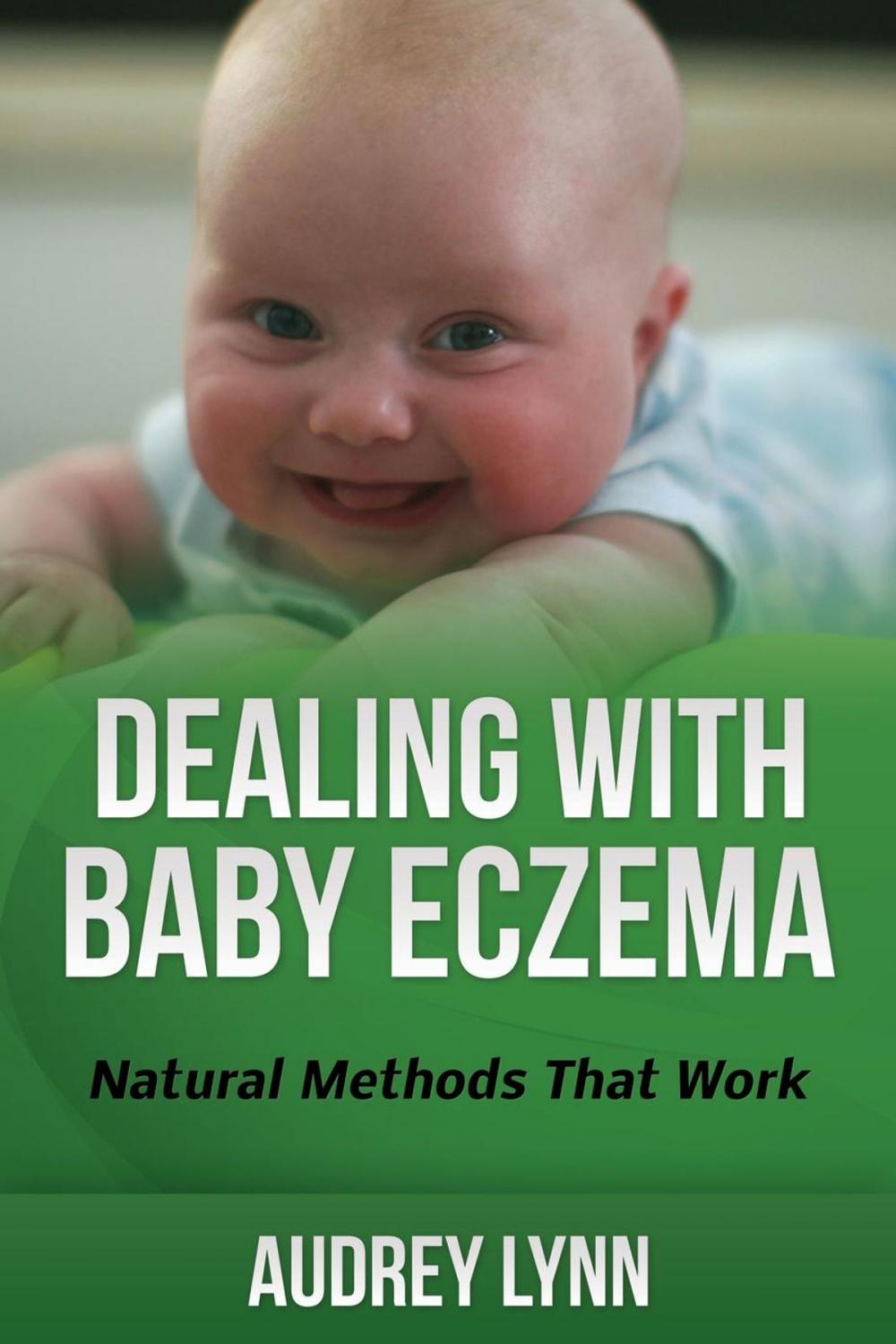 Big bigCover of Dealing With Baby Eczema