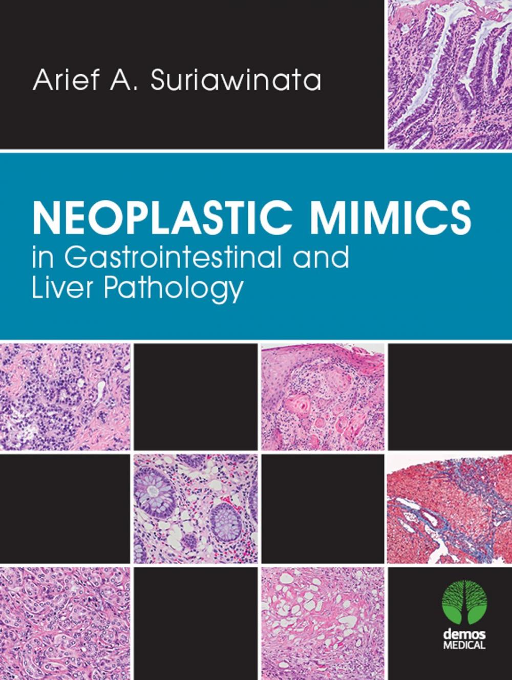 Big bigCover of Neoplastic Mimics in Gastrointestinal and Liver Pathology