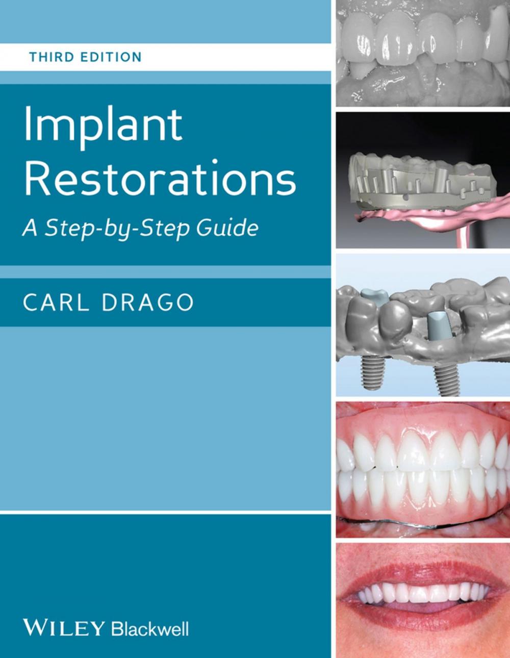 Big bigCover of Implant Restorations