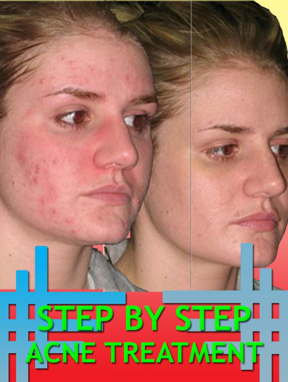 Big bigCover of Step By Step Acne Treatment