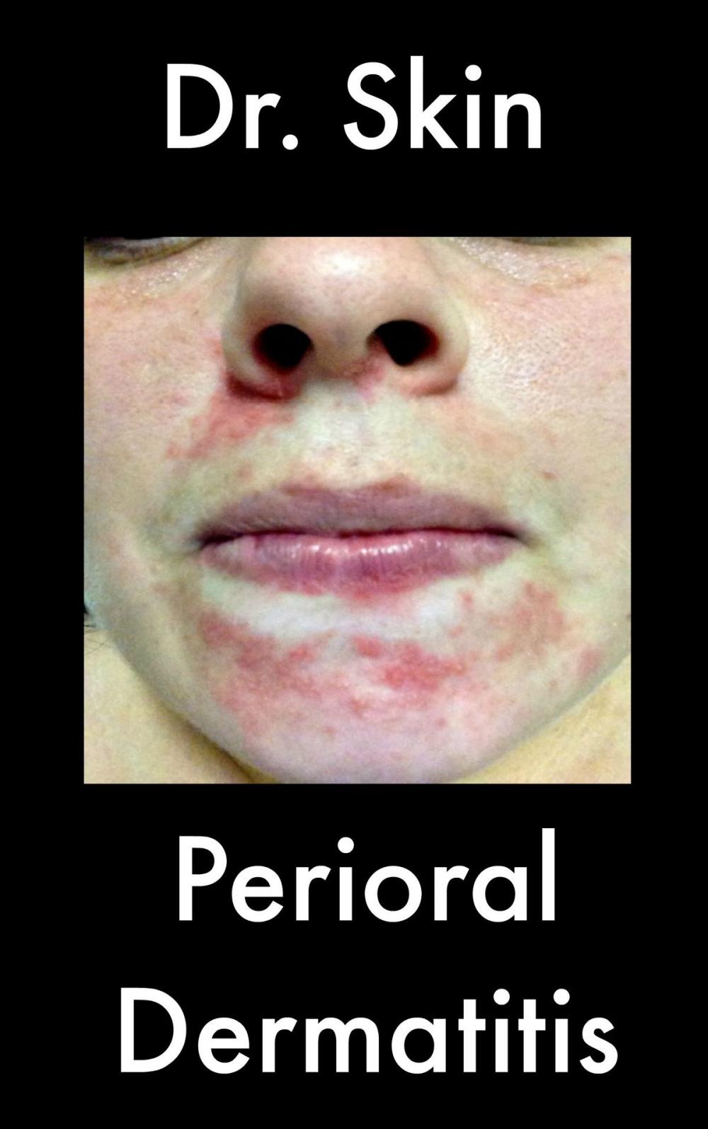 Big bigCover of Perioral Dermatitis