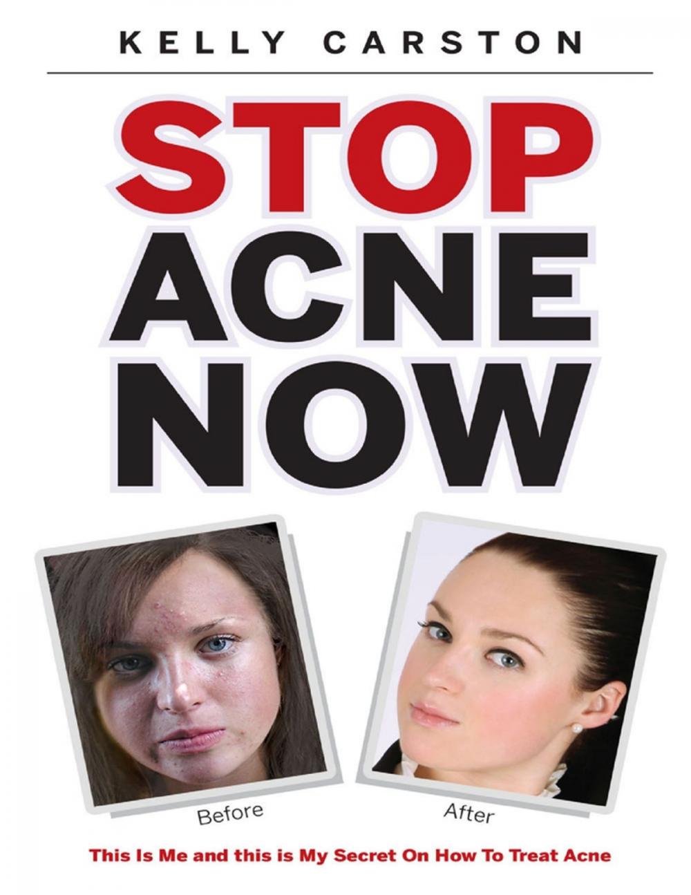 Big bigCover of Stop Acne Now: This Is Me and This Is My Secret On How to Treat Acne