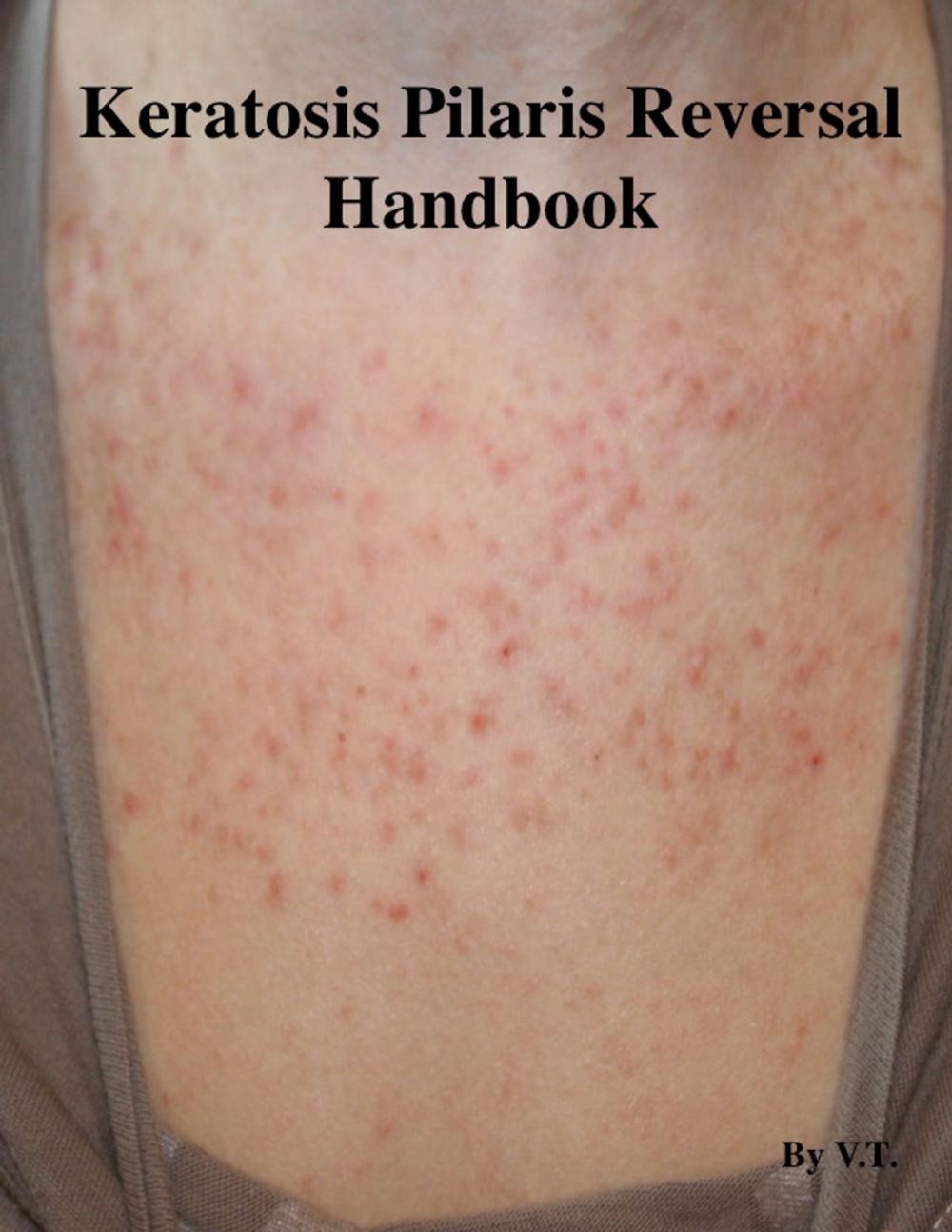 Big bigCover of Keratosis Pilaris Reversal Handbook