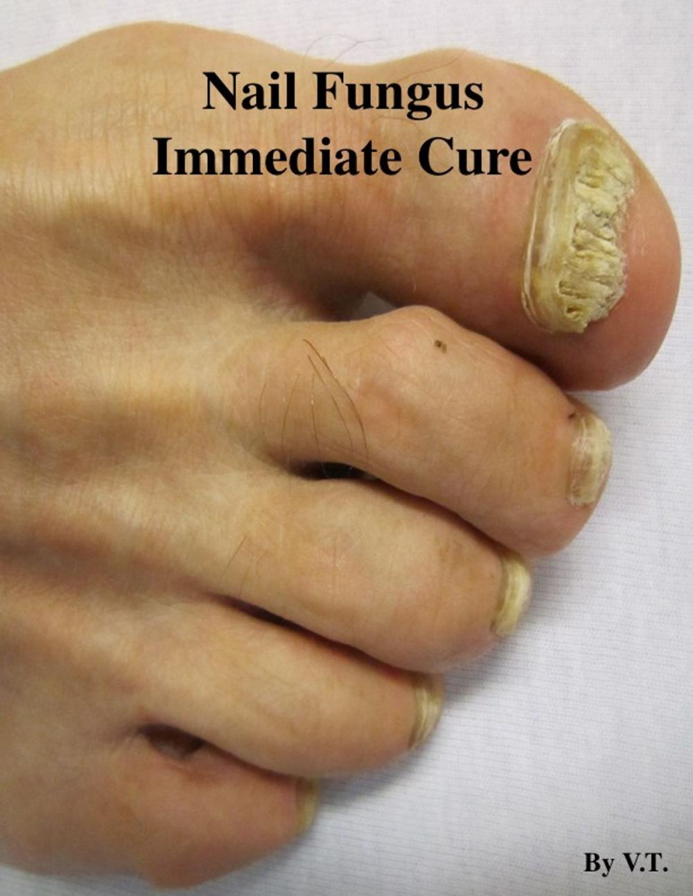 Big bigCover of Nail Fungus Immediate Cure