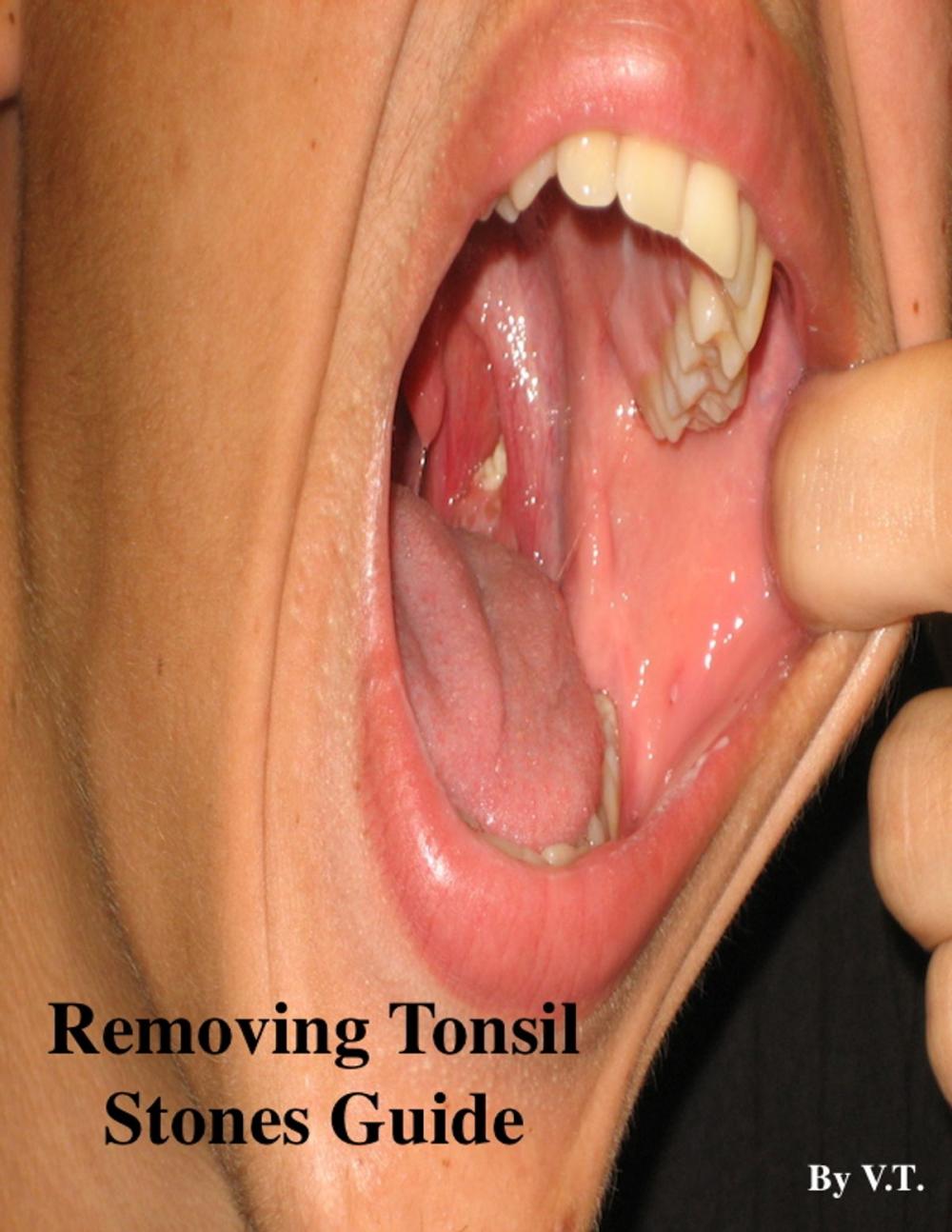 Big bigCover of Removing Tonsil Stones Guide