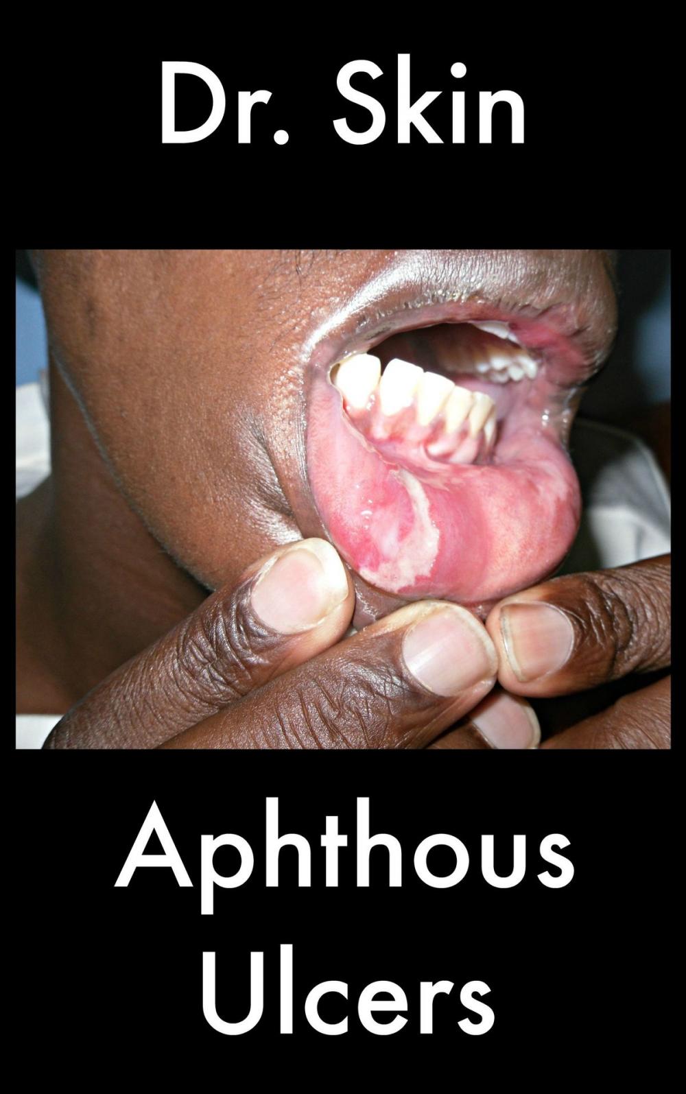 Big bigCover of Aphthous Ulcers